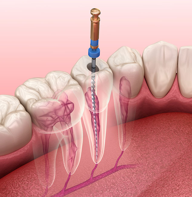 Endodontie-Dentiste-Bordeaux