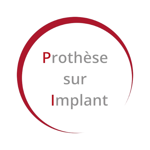 prothese-sur-implant-bordeaux-dentiste